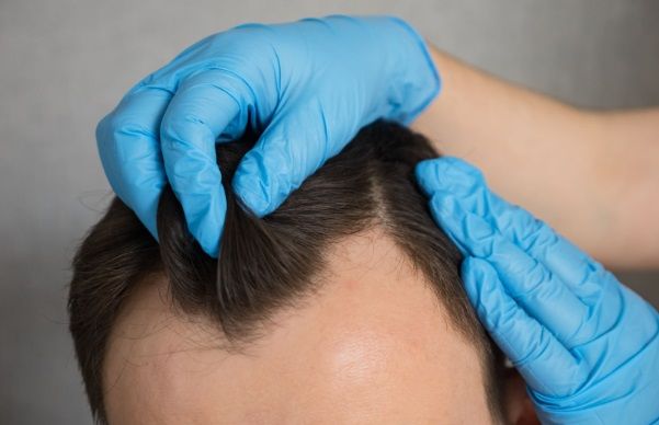 Médico revisando el cabello de un paciente para ver la caída del pelo que presenta