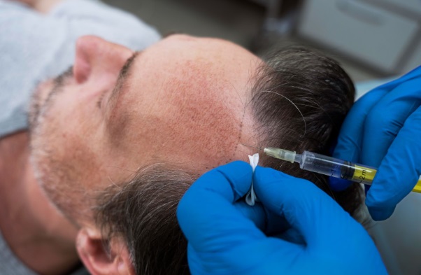 Soluciones no quirúrgicas para el tratamiento de la caída del cabello