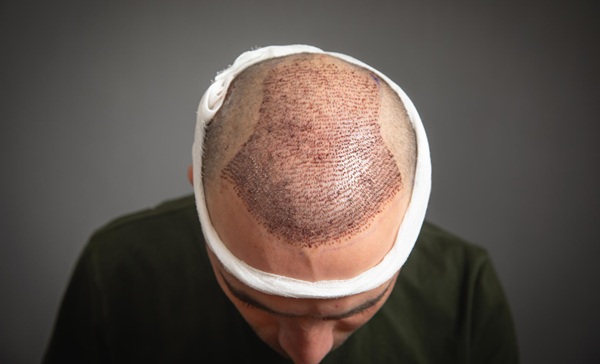Hombre mostrando su cabeza poco después de un trasplante capilar