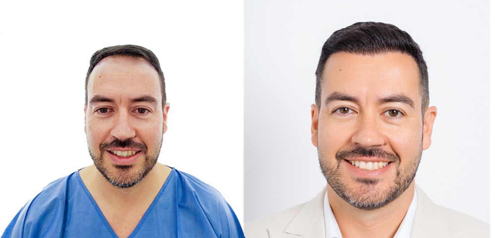 Foto antes y después de paciente de Capilclinic